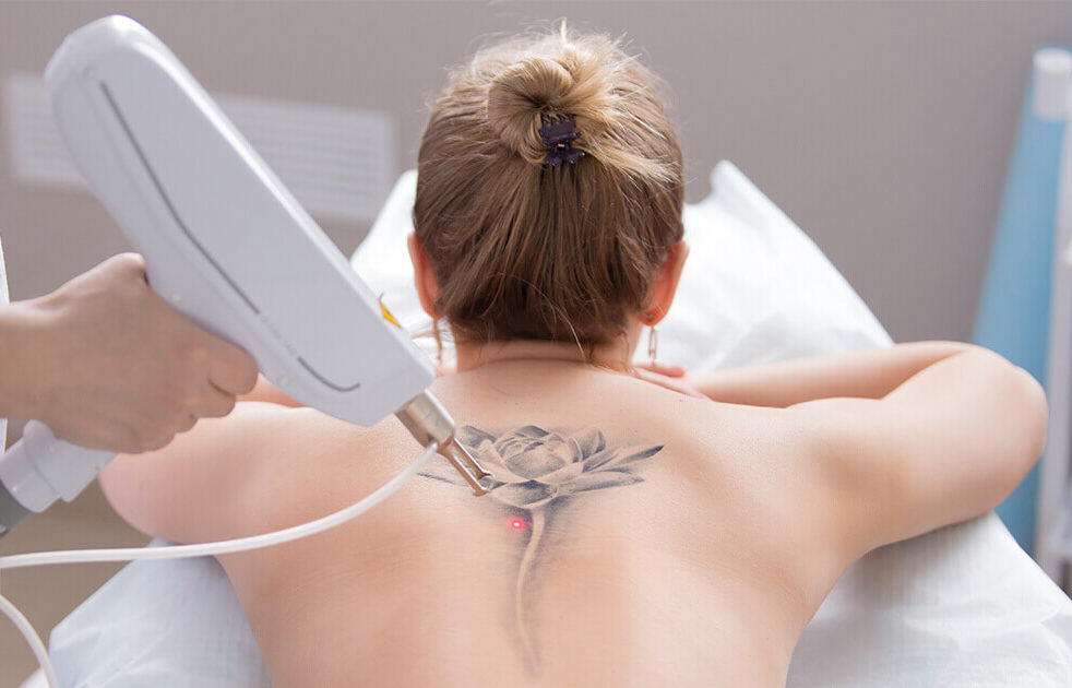 body tattoo removal by laser 1 e1726479571144